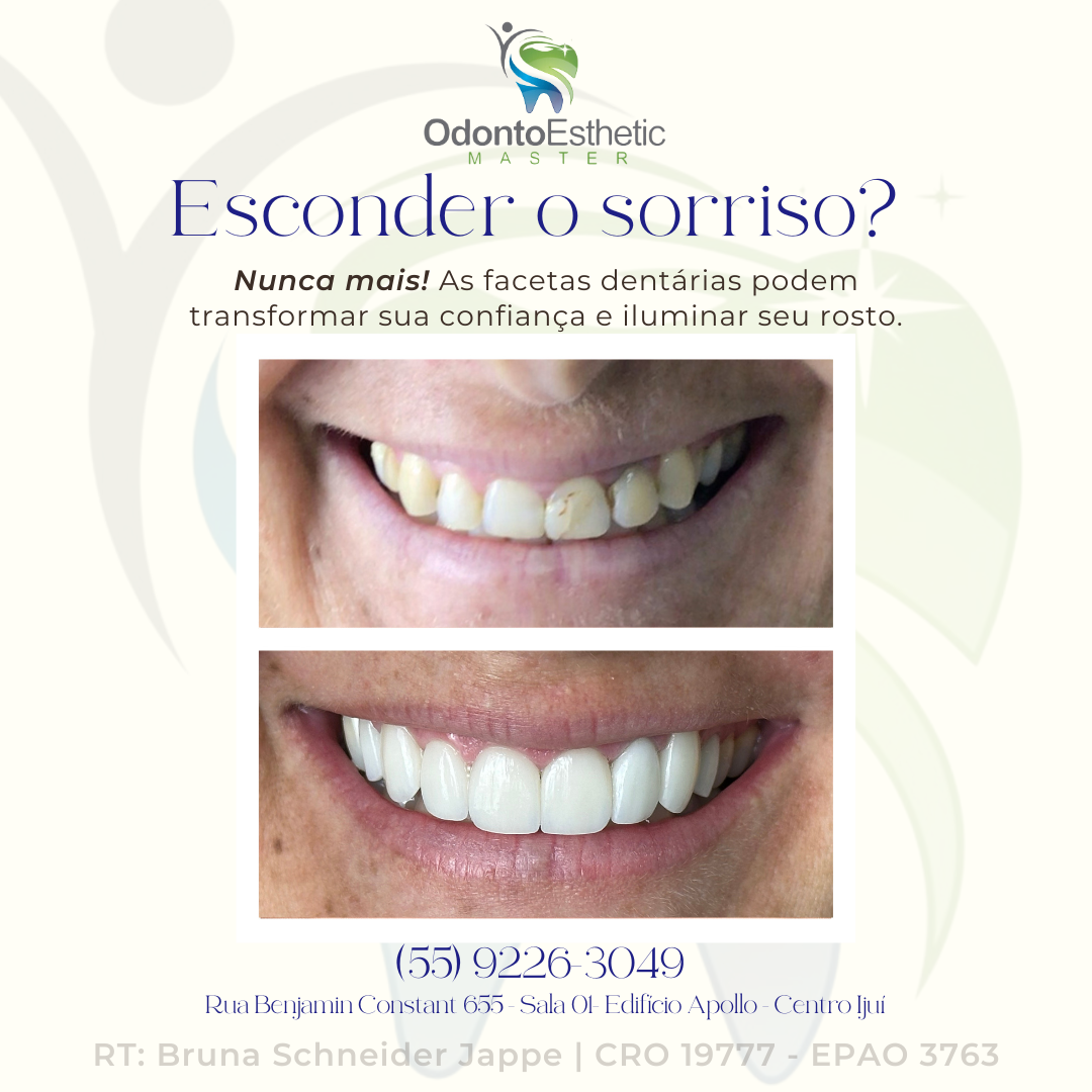 Publicação sobre facetas dentárias
