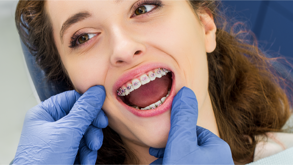 Aparelhos dentários