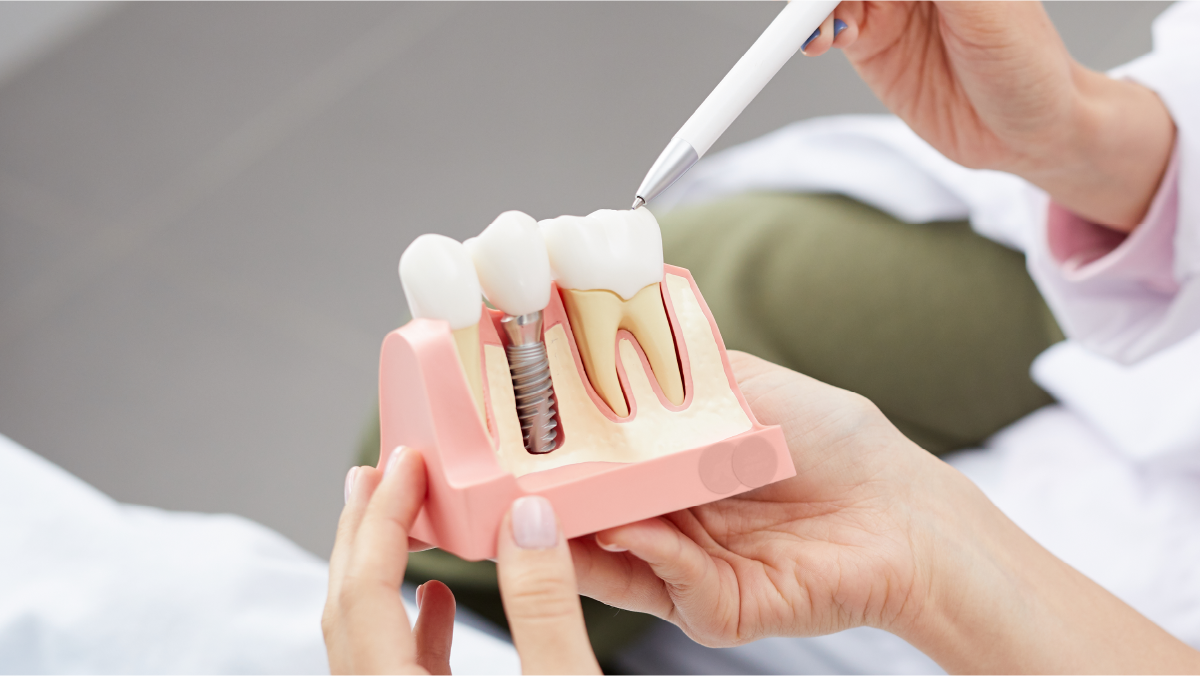 Implantes dentários